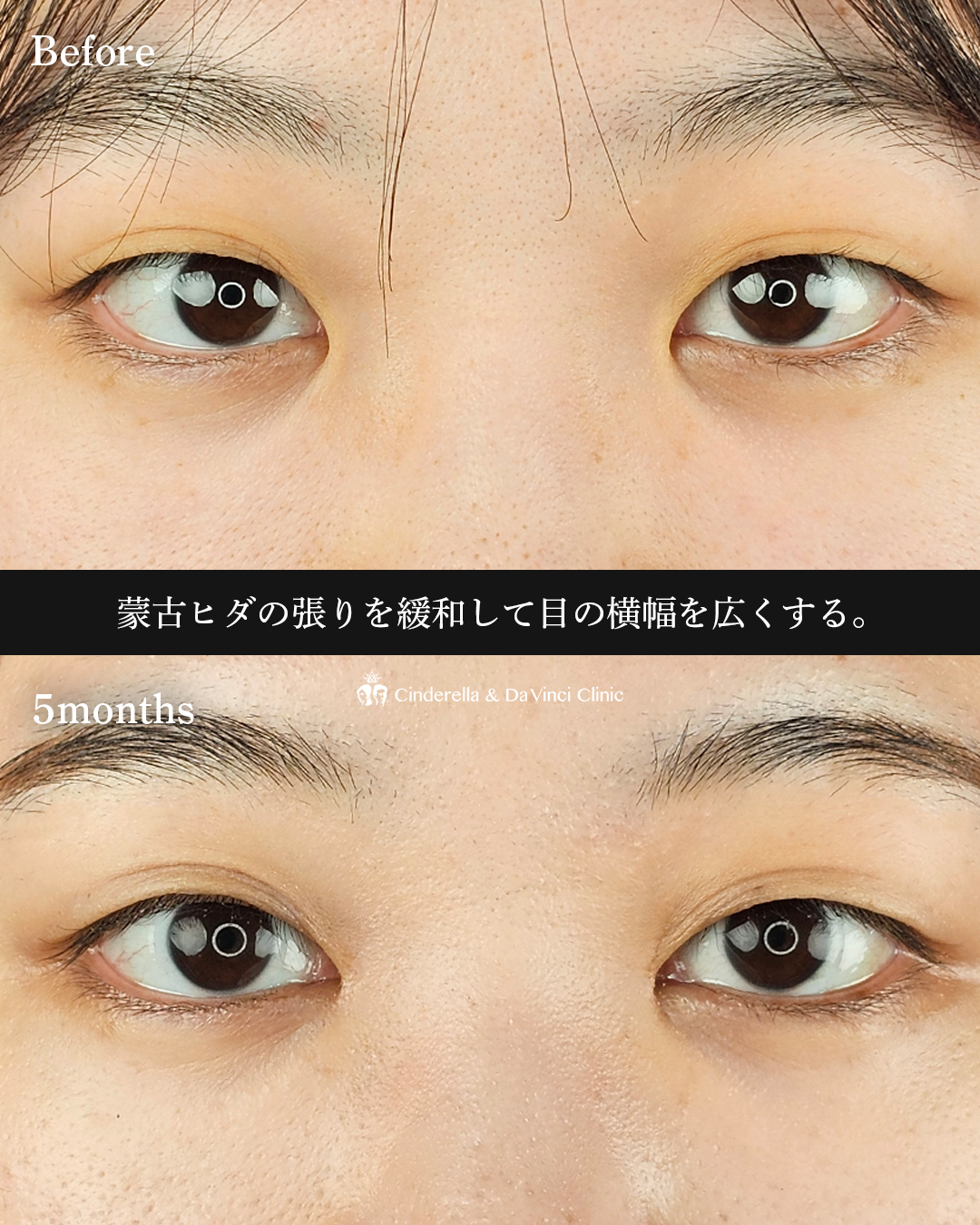目頭切開のみの画像