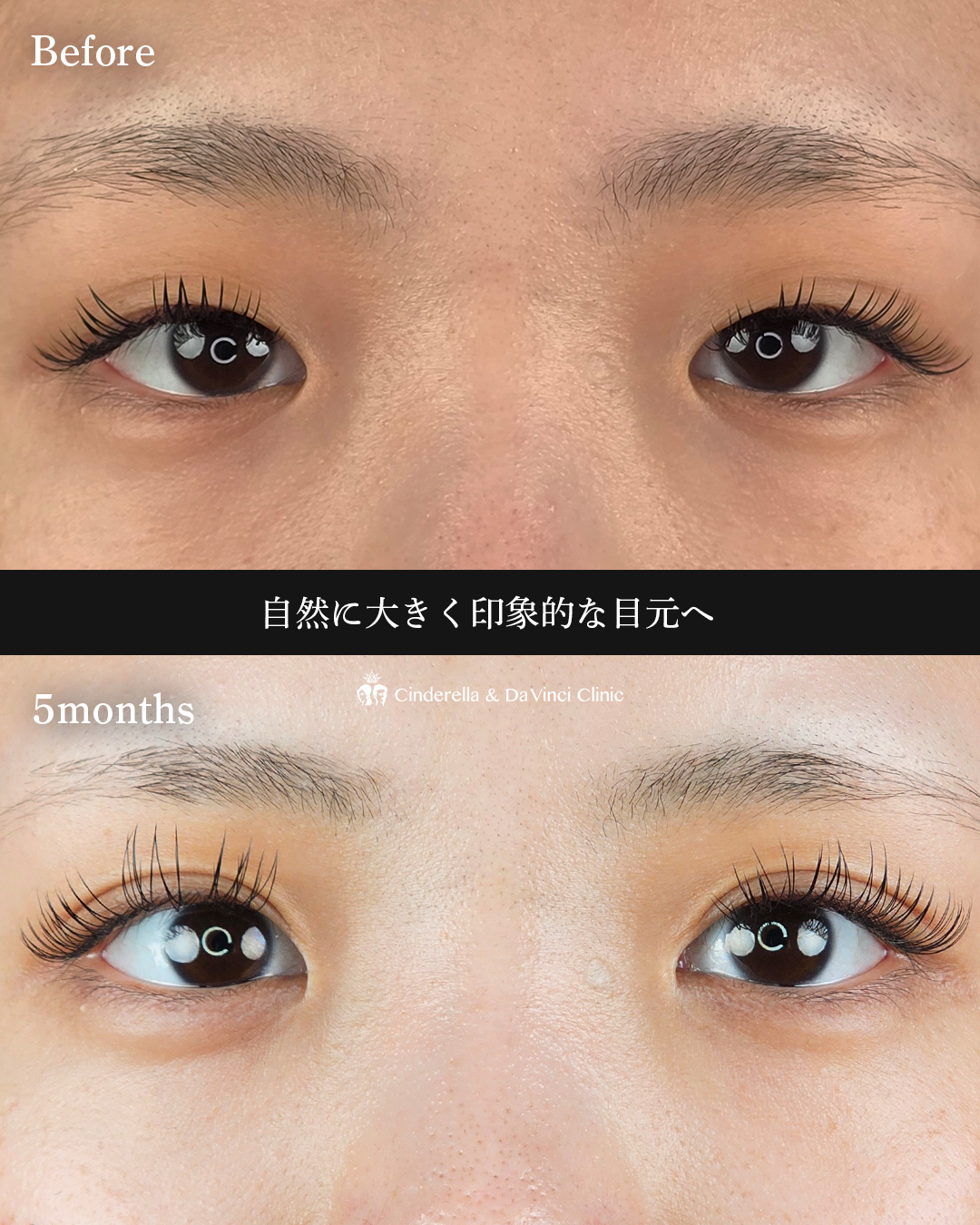 埋没と目頭同時手術の画像