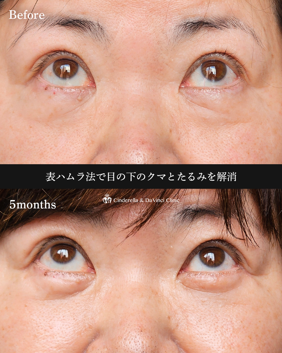 表ハムラで目元スッキリの画像
