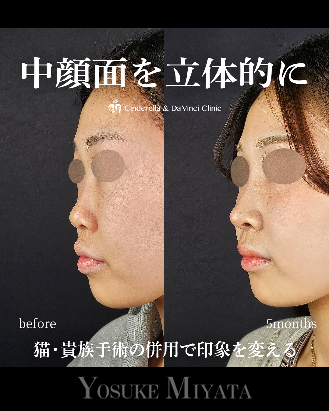 中顔面を立体的にの画像