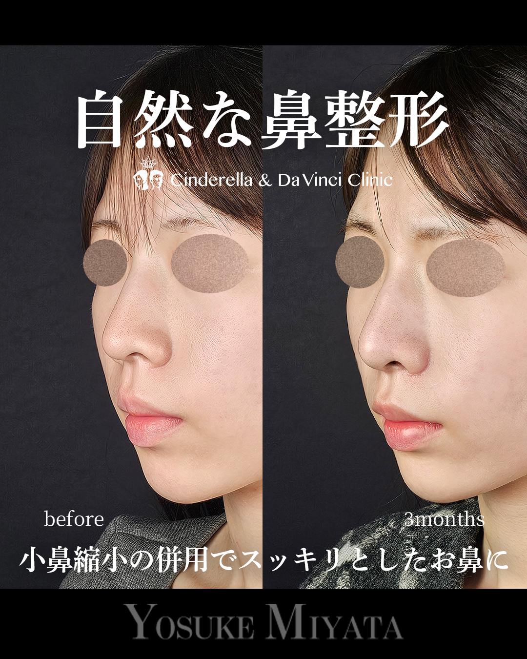 自然な鼻整形の画像