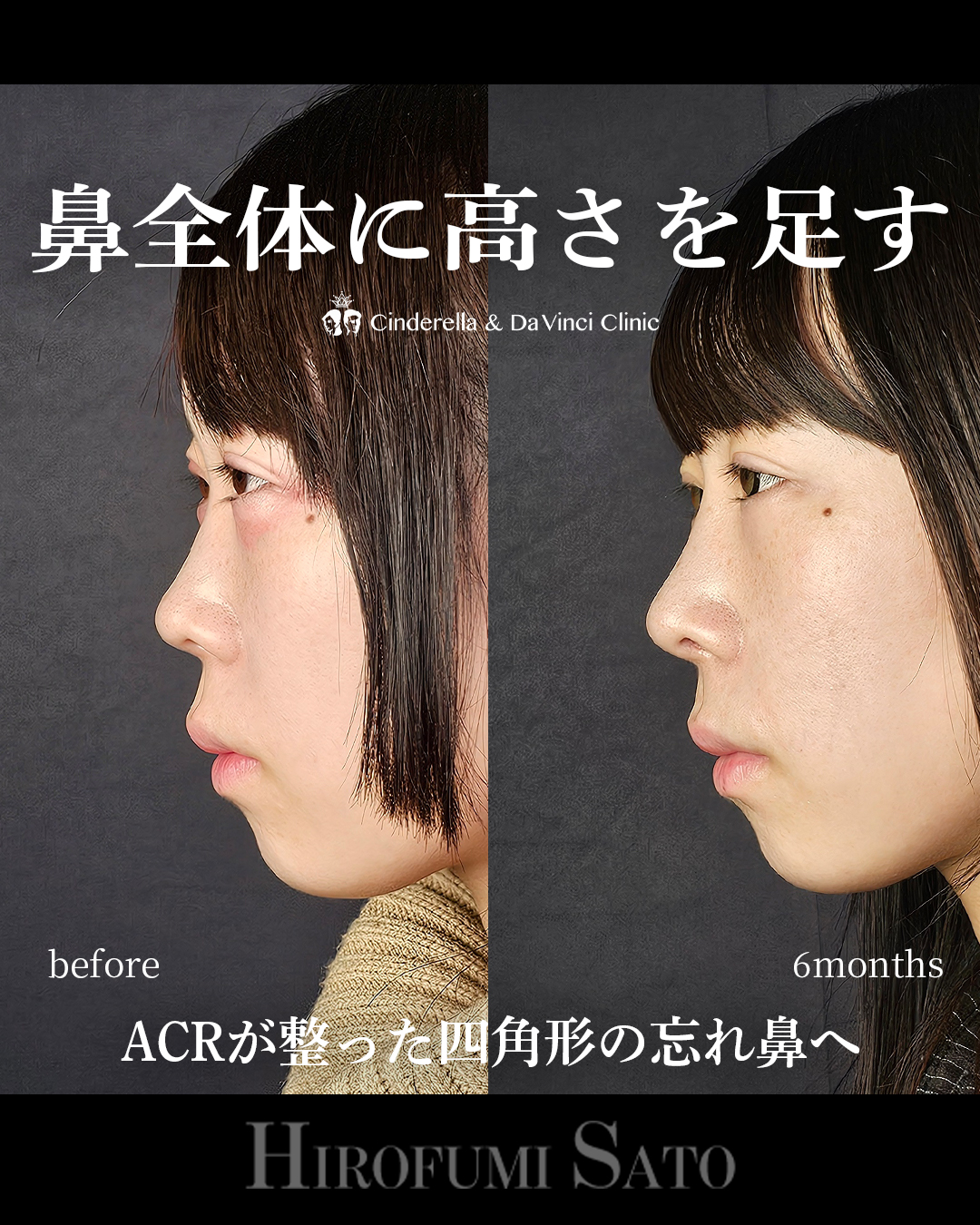 鼻に高さを足すの画像