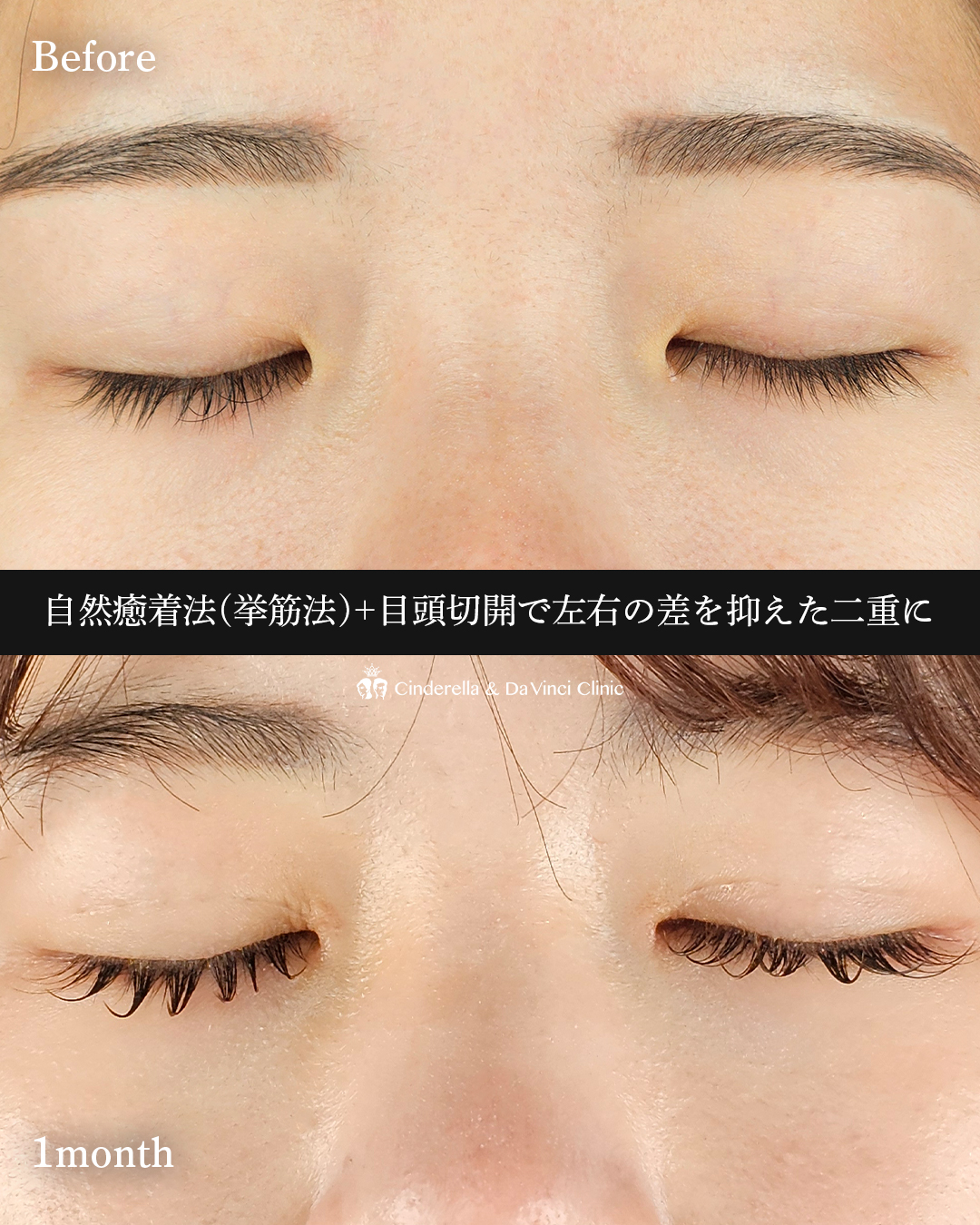 自然癒着法×目頭の画像