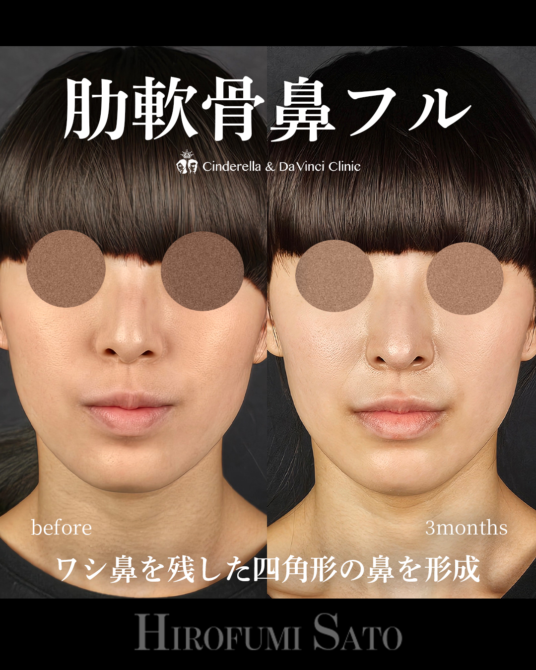 鷲鼻を残した鼻整形の画像