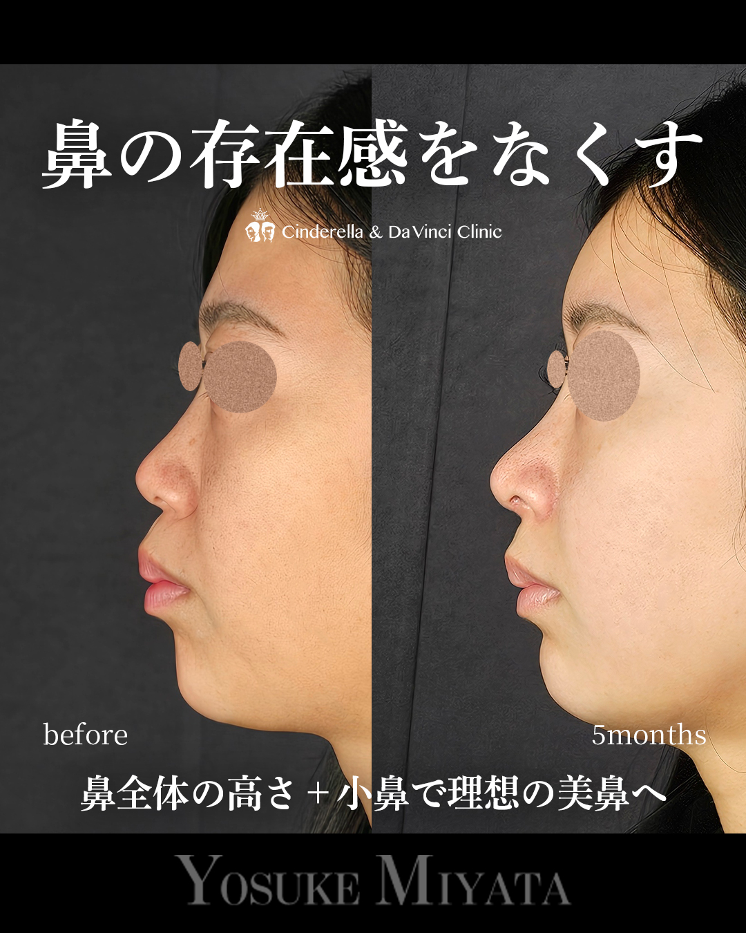 鼻の存在感をなくすの画像