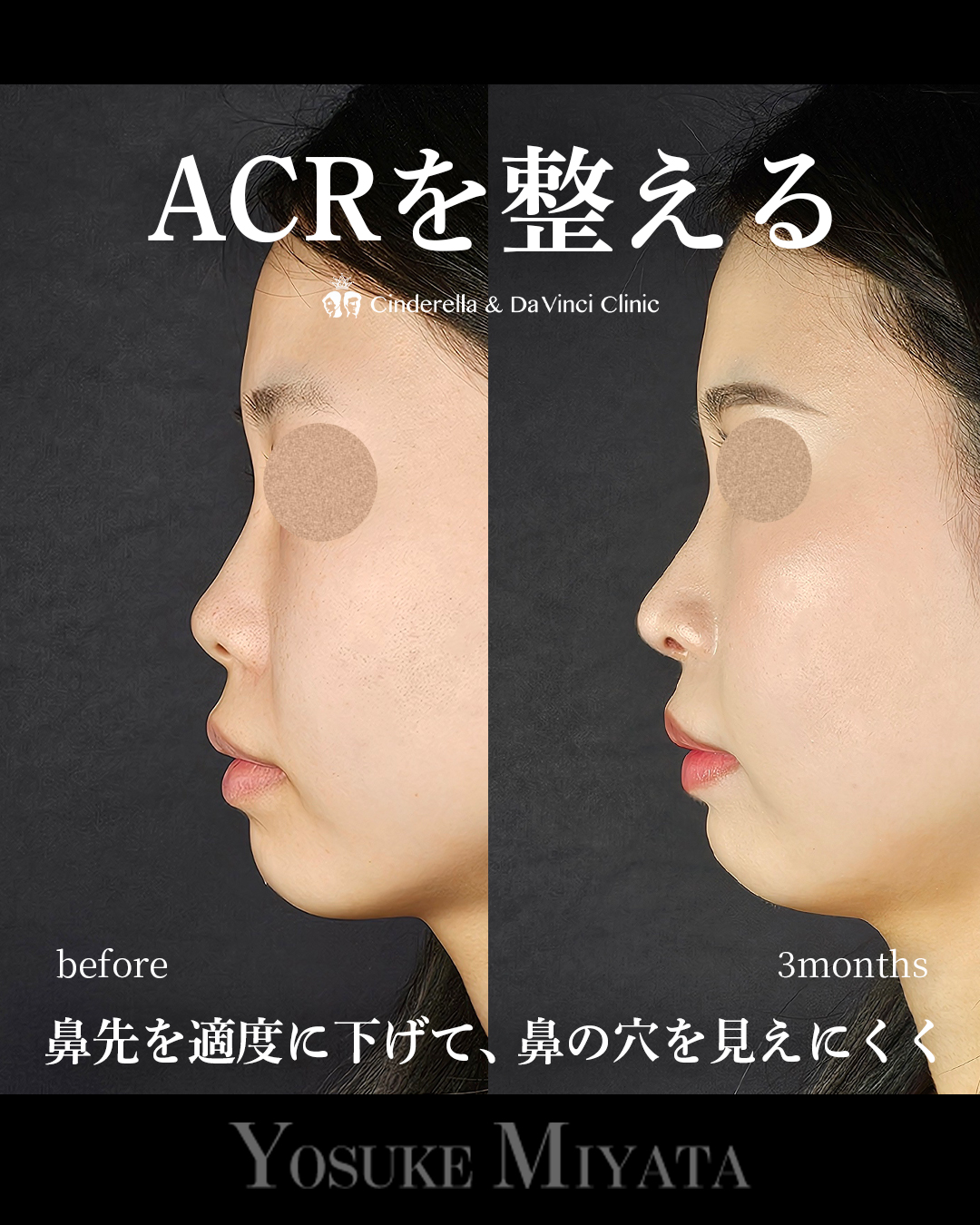 ACRを整えるの画像