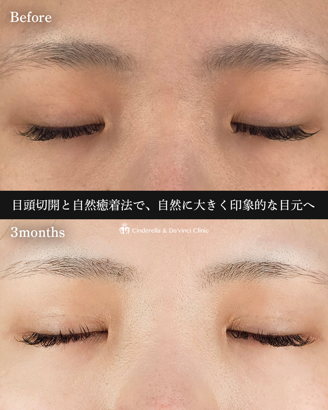 埋没と目頭同時手術の画像
