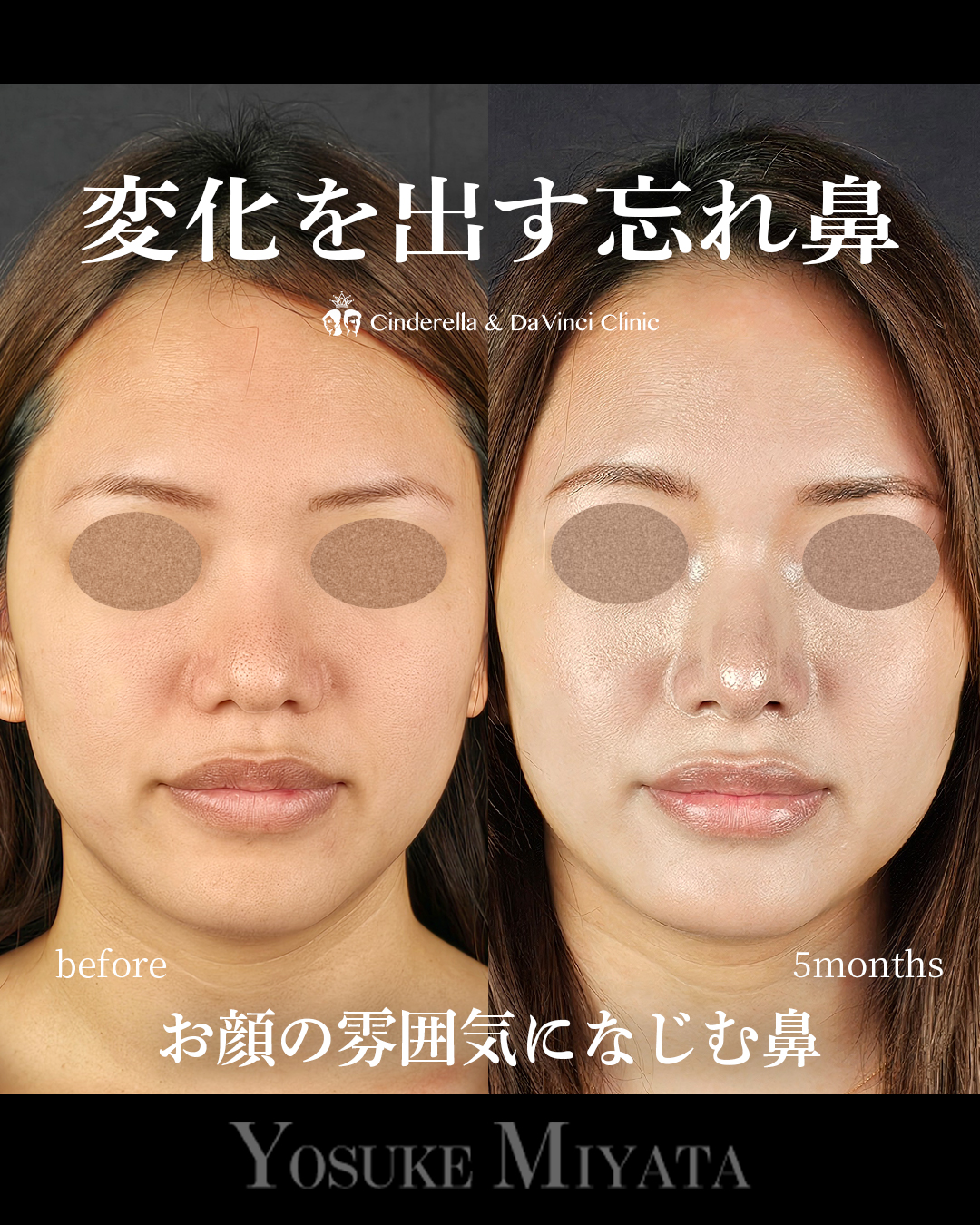 ナチュラルな忘れ鼻の画像