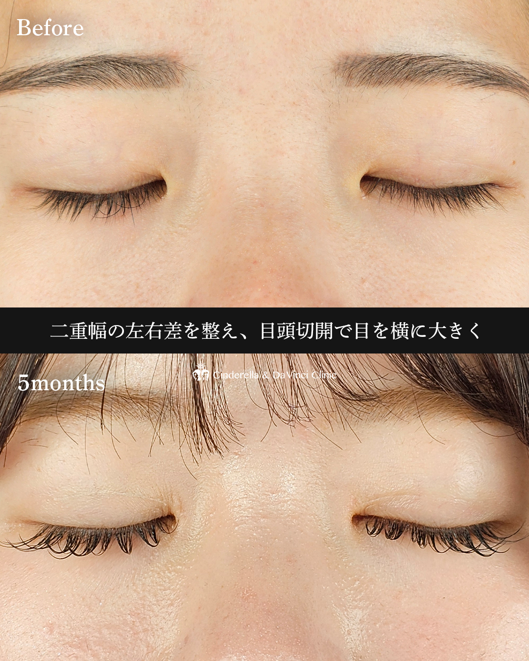 自然癒着法×目頭の画像