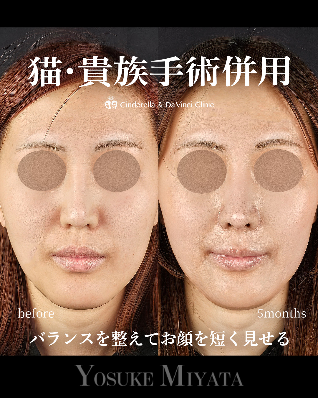 鼻整形で面長改善の画像