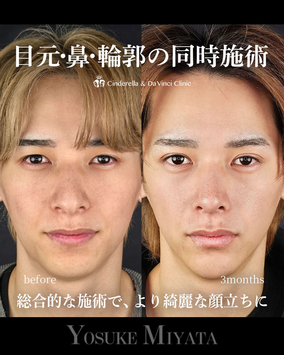 お顔全体アプデの画像