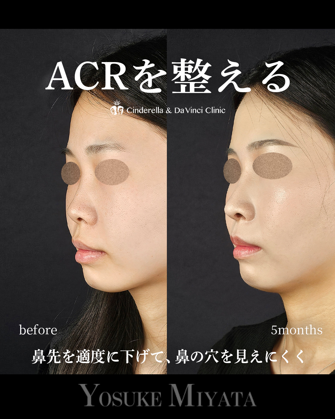 ACRを整えるの画像