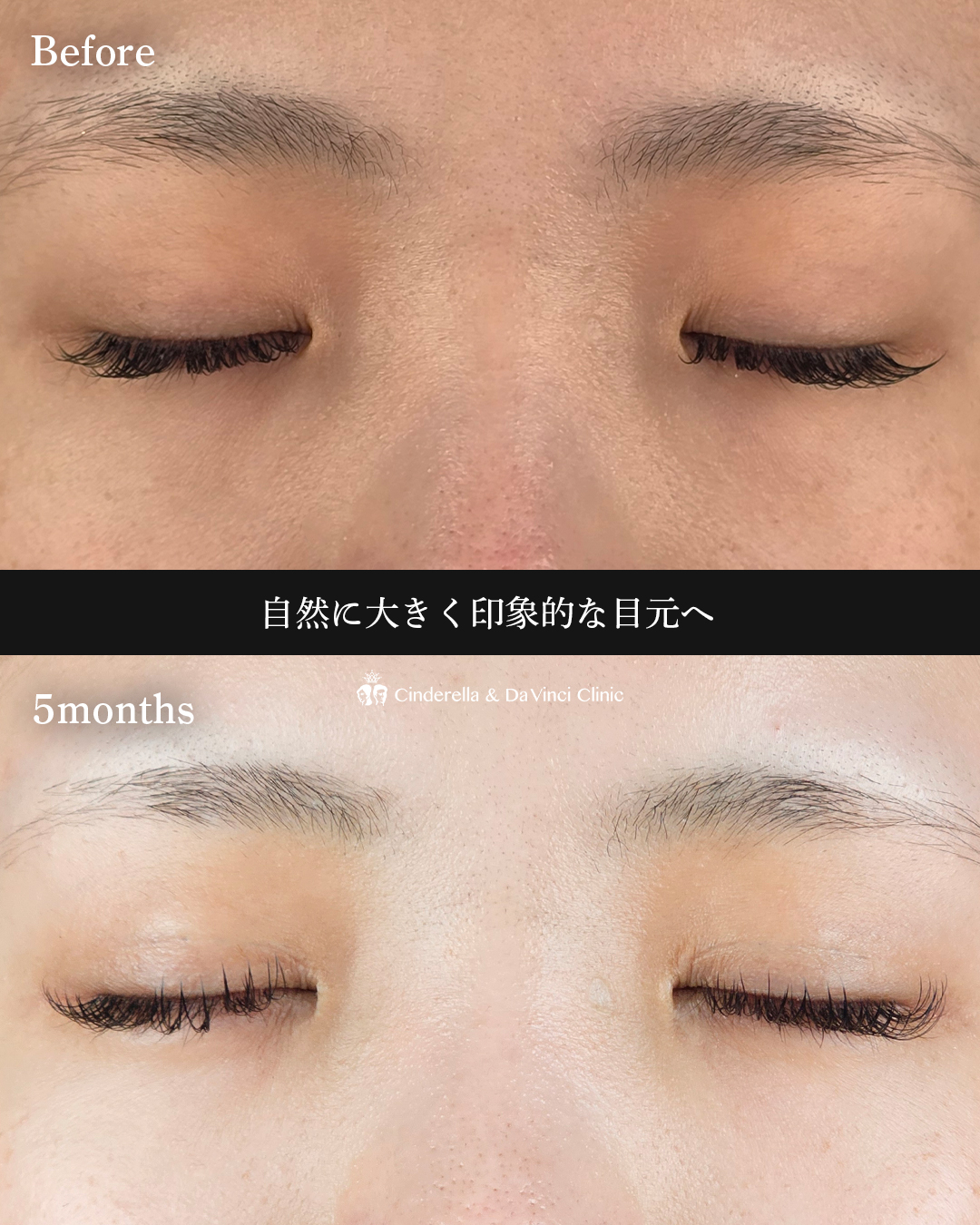 埋没と目頭同時手術の画像