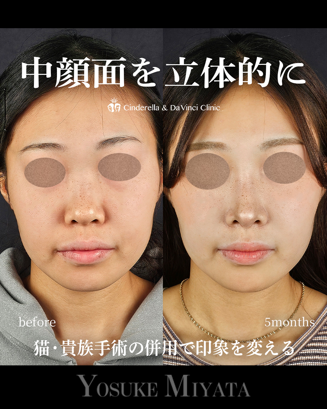 中顔面を立体的にの画像