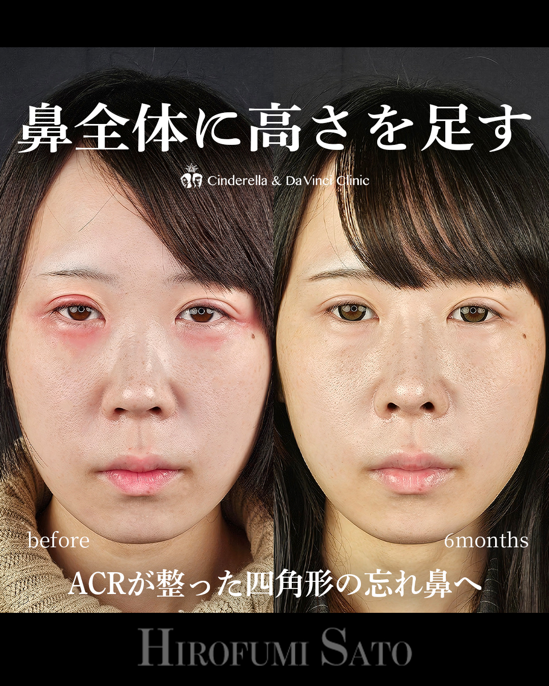 鼻に高さを足すの画像