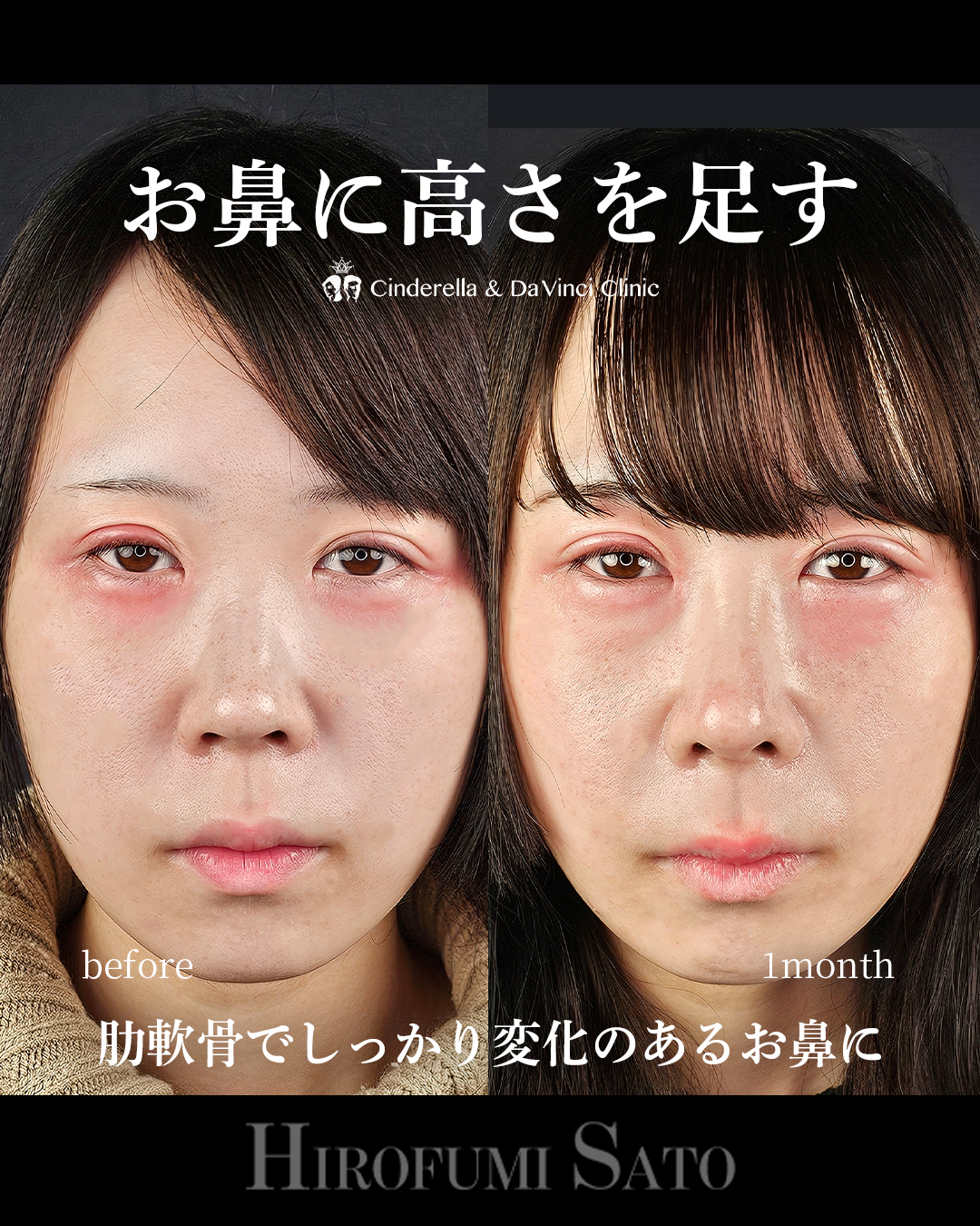 鼻に高さを足すの画像