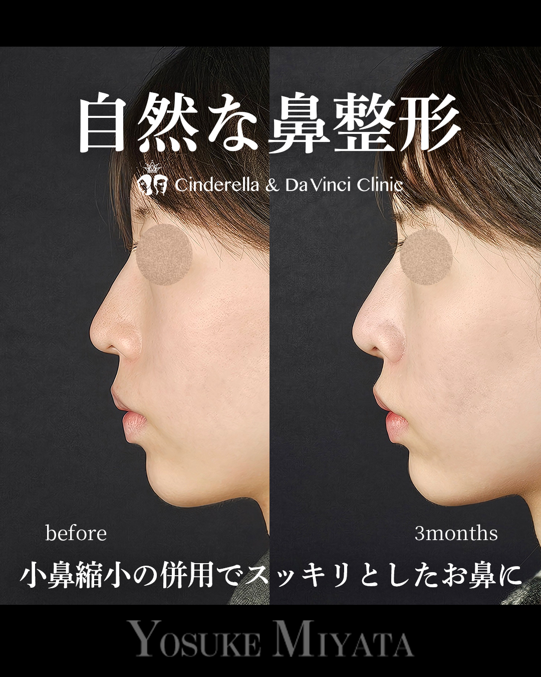 自然な鼻整形の画像