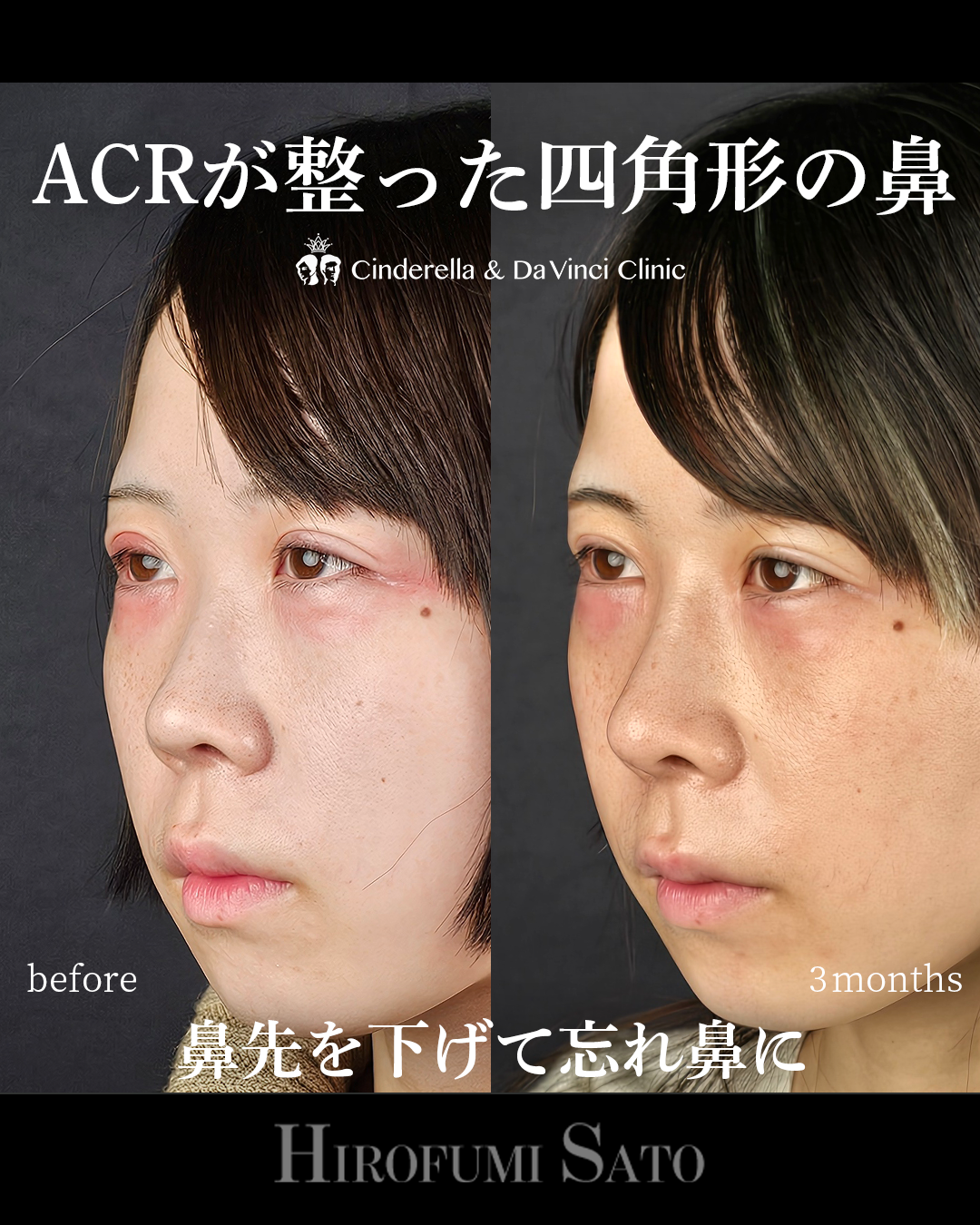 鼻に高さを足すの画像