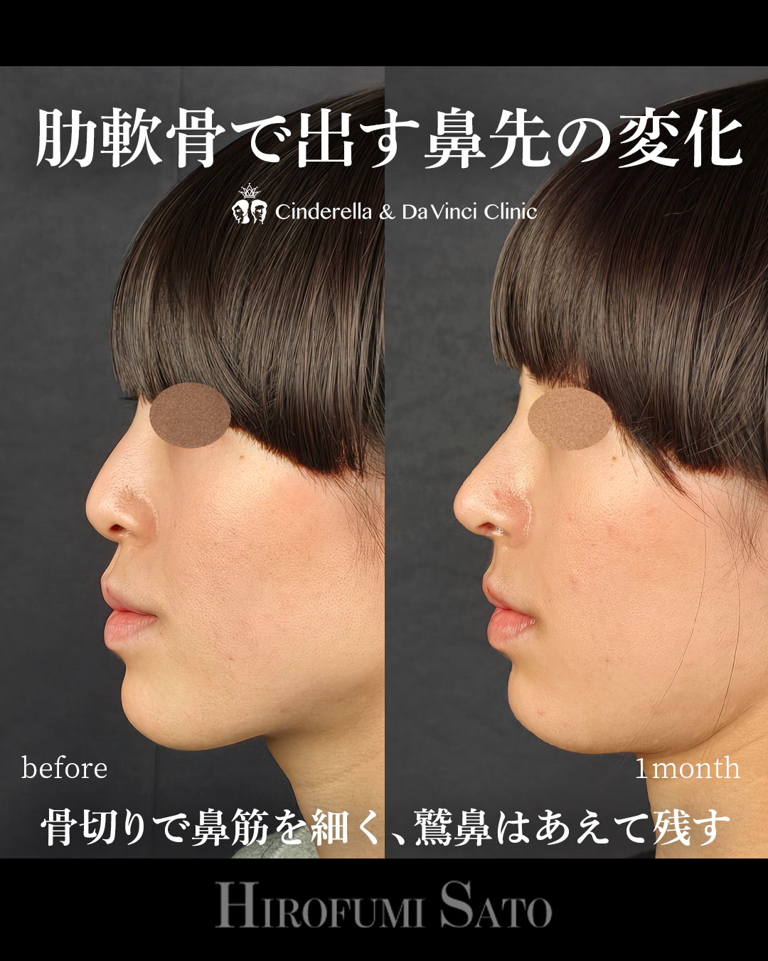 鷲鼻を残した鼻整形