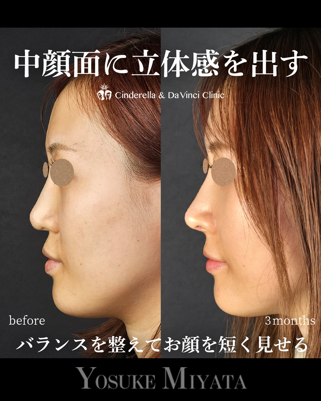 鼻整形で面長改善の画像