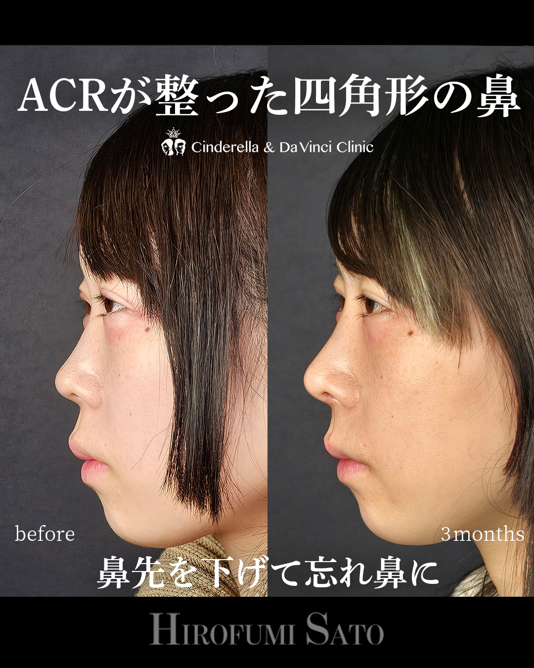 鼻に高さを足すの画像