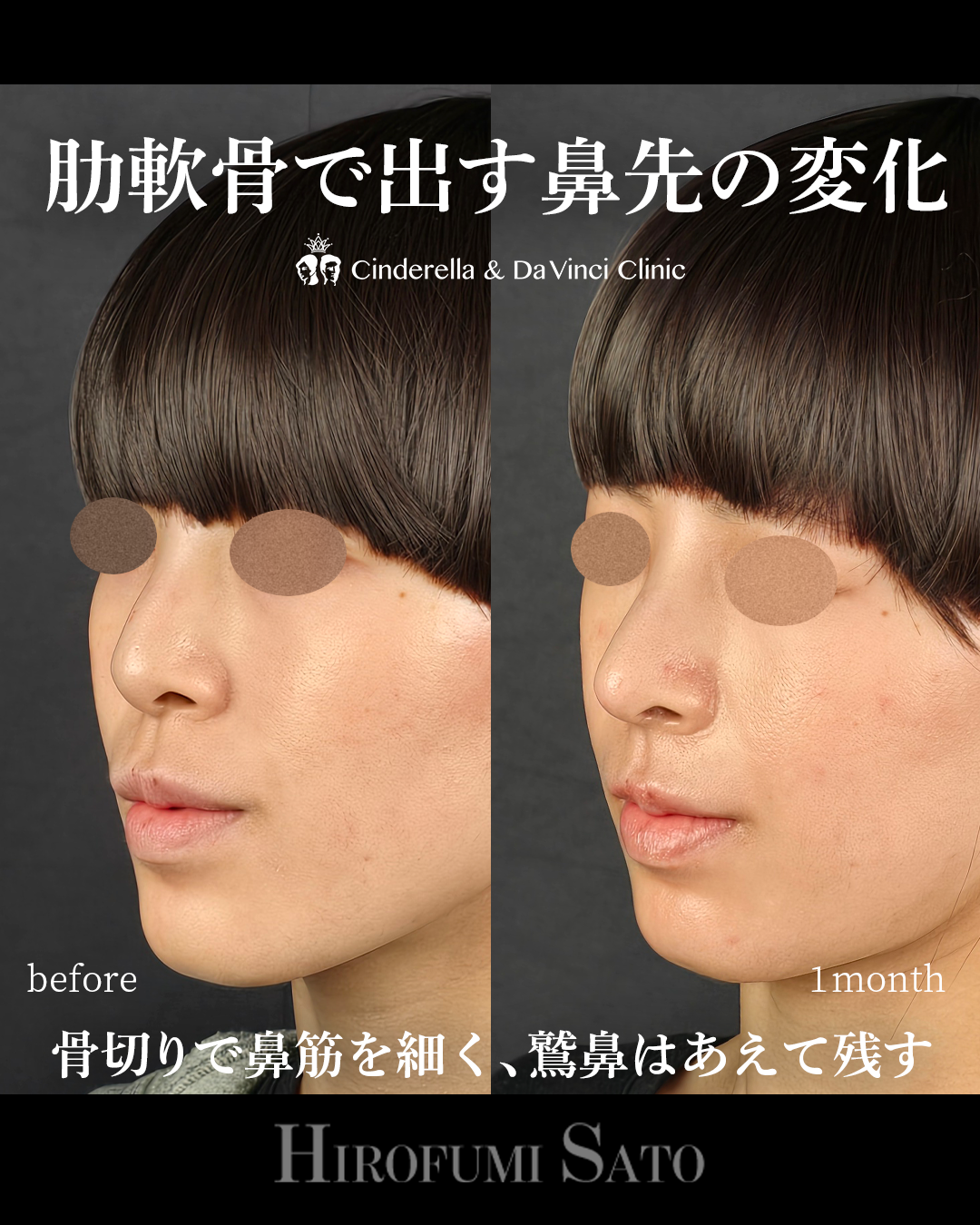 鷲鼻を残した鼻整形の画像