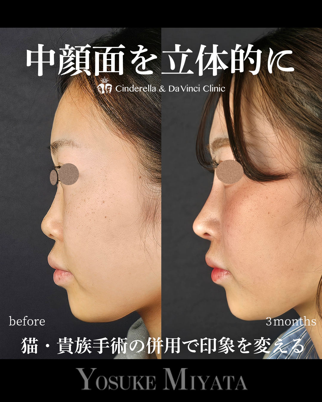 中顔面を立体的にの画像
