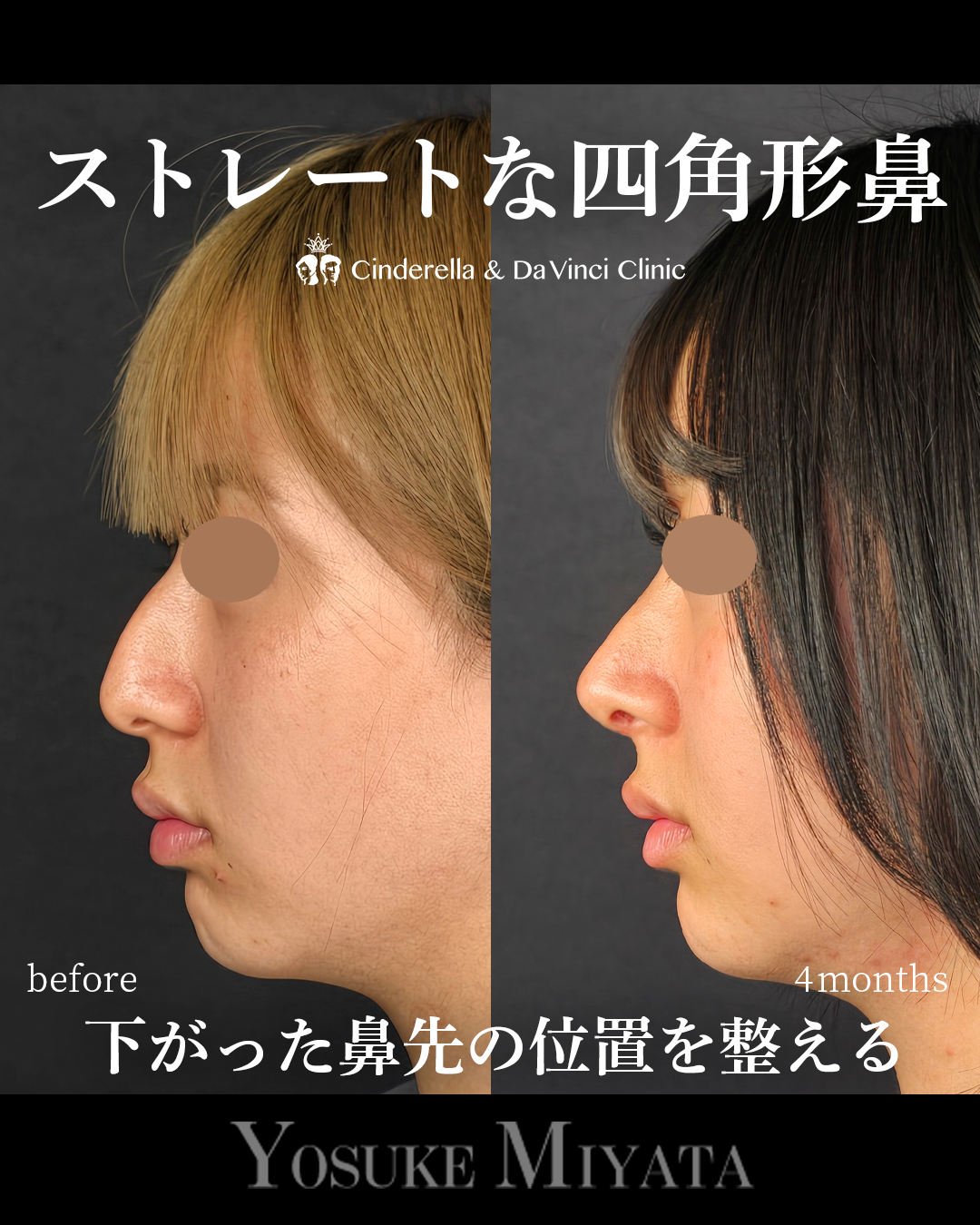 ストレートな四角形鼻