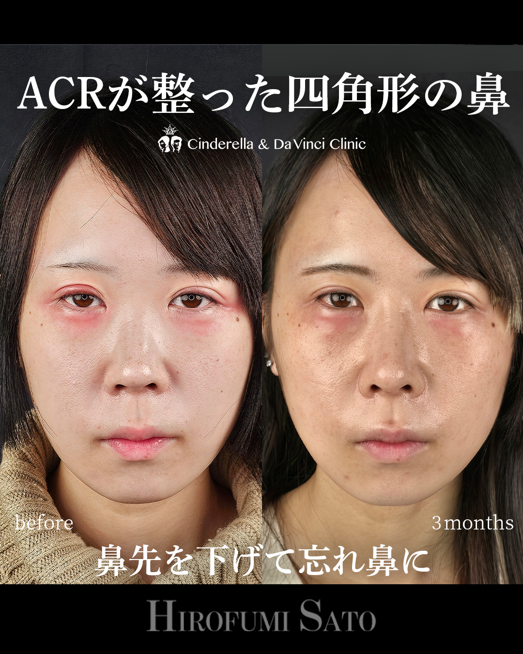鼻に高さを足すの画像
