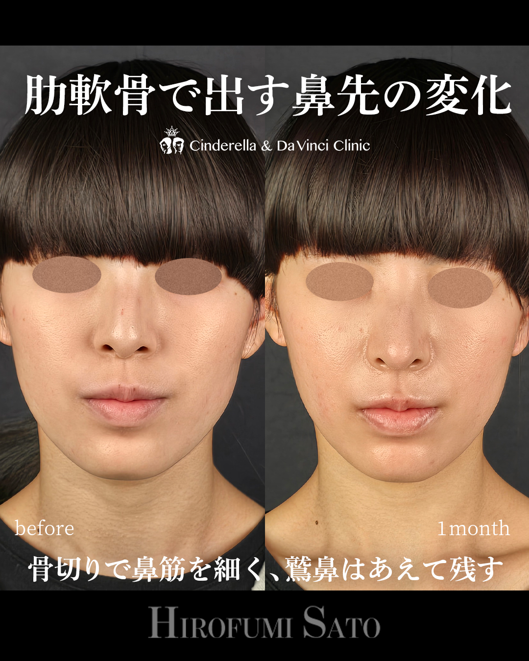 鷲鼻を残した鼻整形の画像