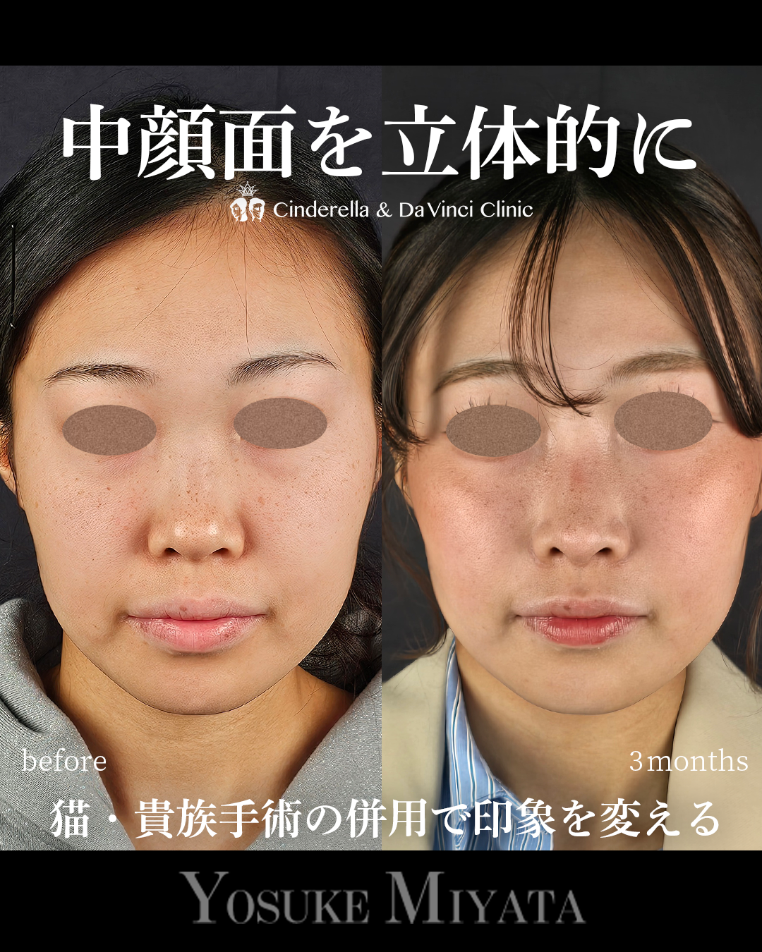 中顔面を立体的にの画像