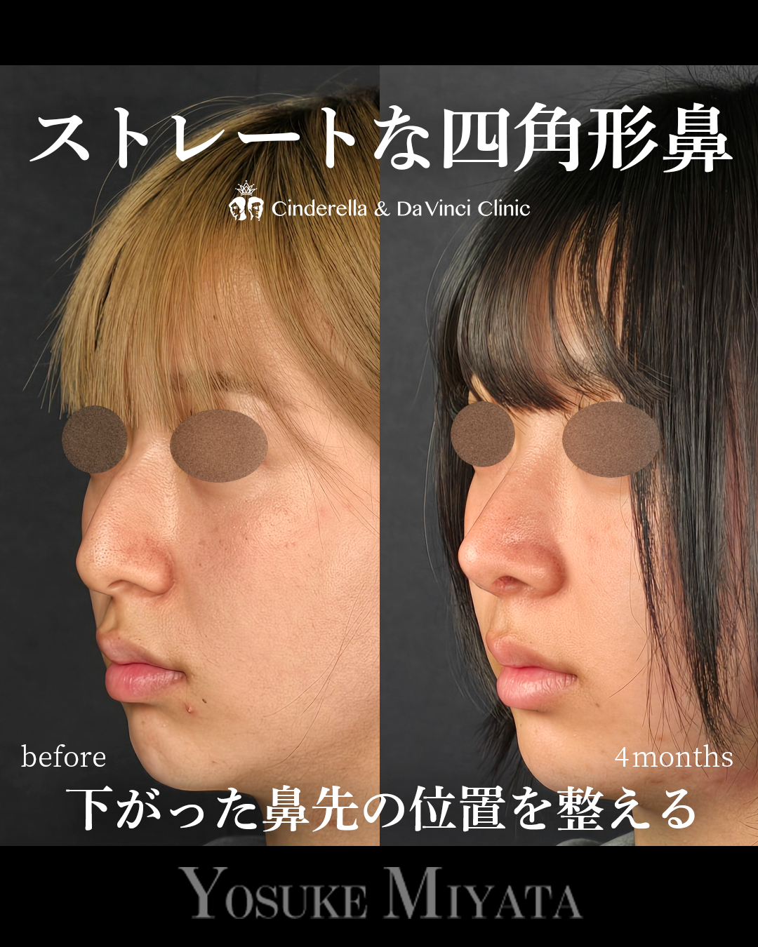 ストレートな四角形鼻の画像