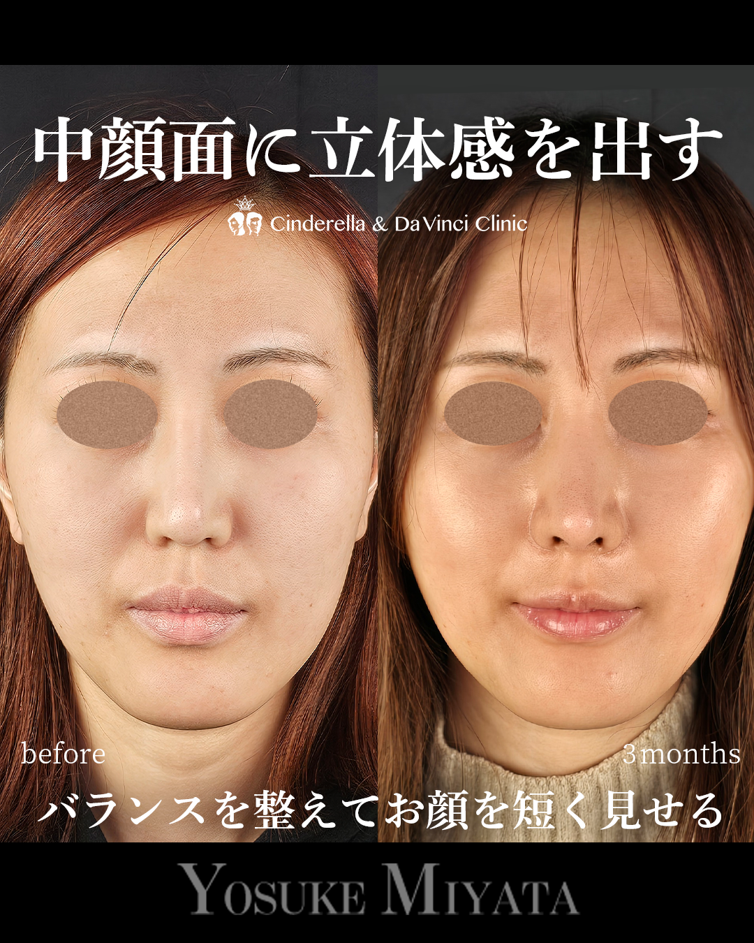 鼻整形で面長改善の画像