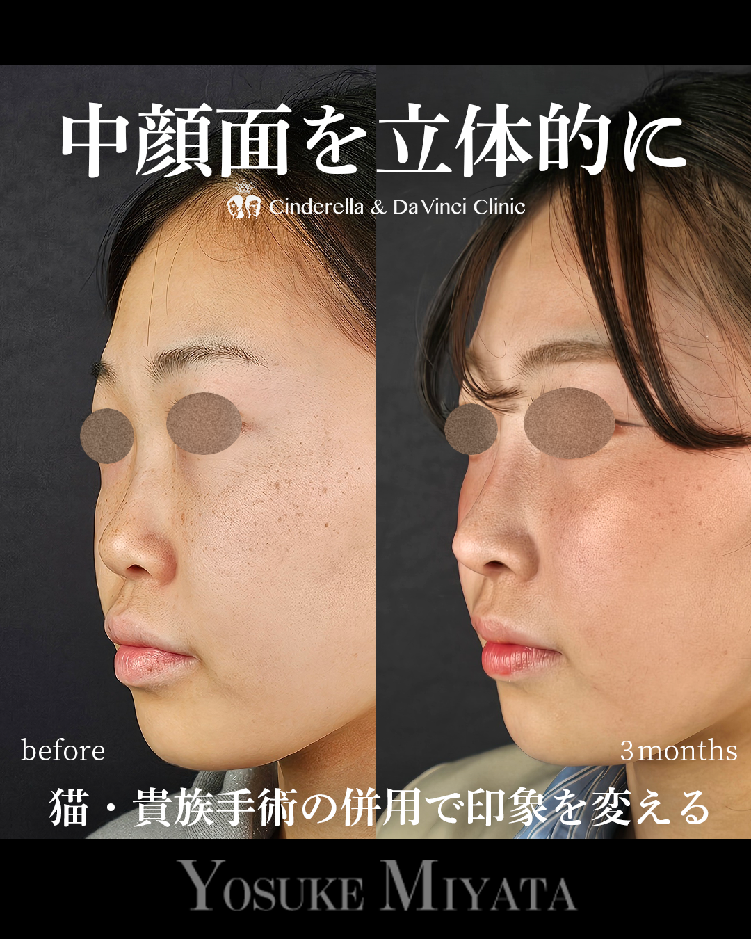 中顔面を立体的にの画像