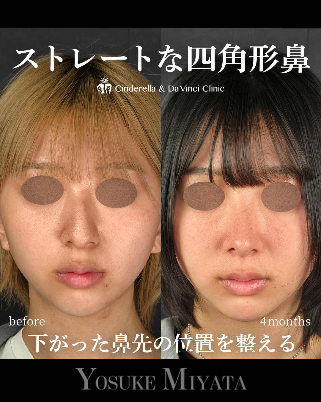 ストレートな四角形鼻の画像