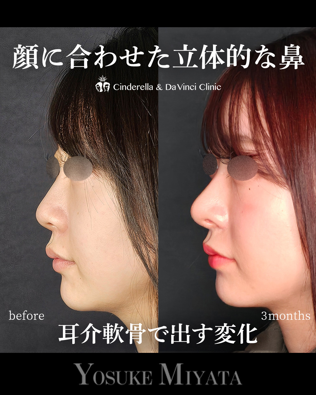 小鼻を小さくして忘れ鼻に