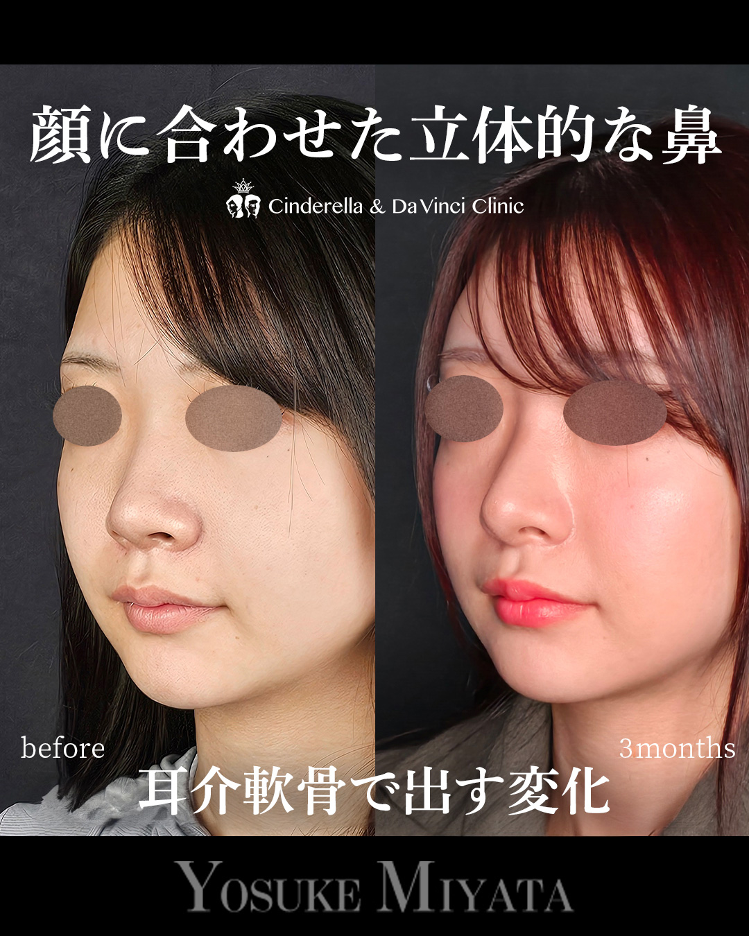 小鼻を小さくして忘れ鼻にの画像