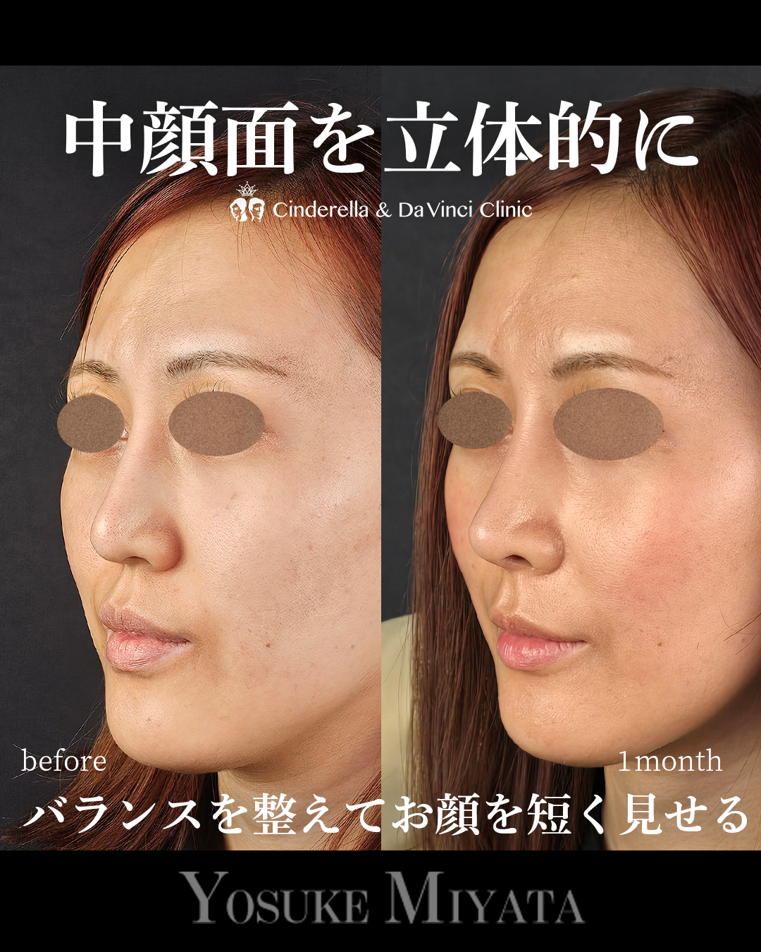 鼻整形で面長改善の画像