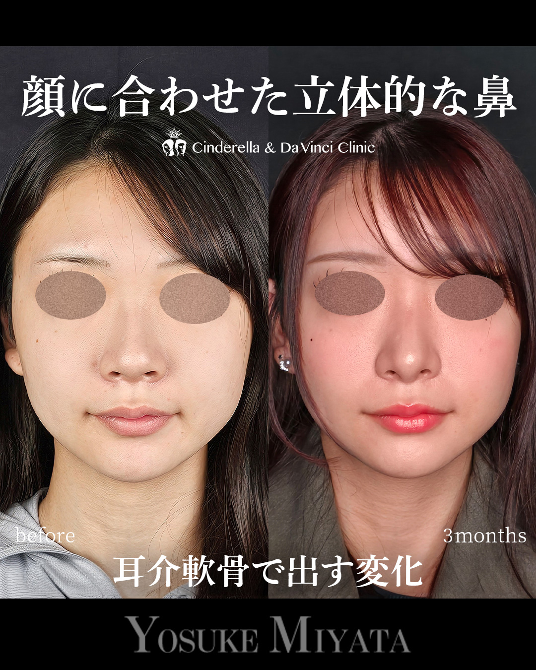 小鼻を小さくして忘れ鼻にの画像