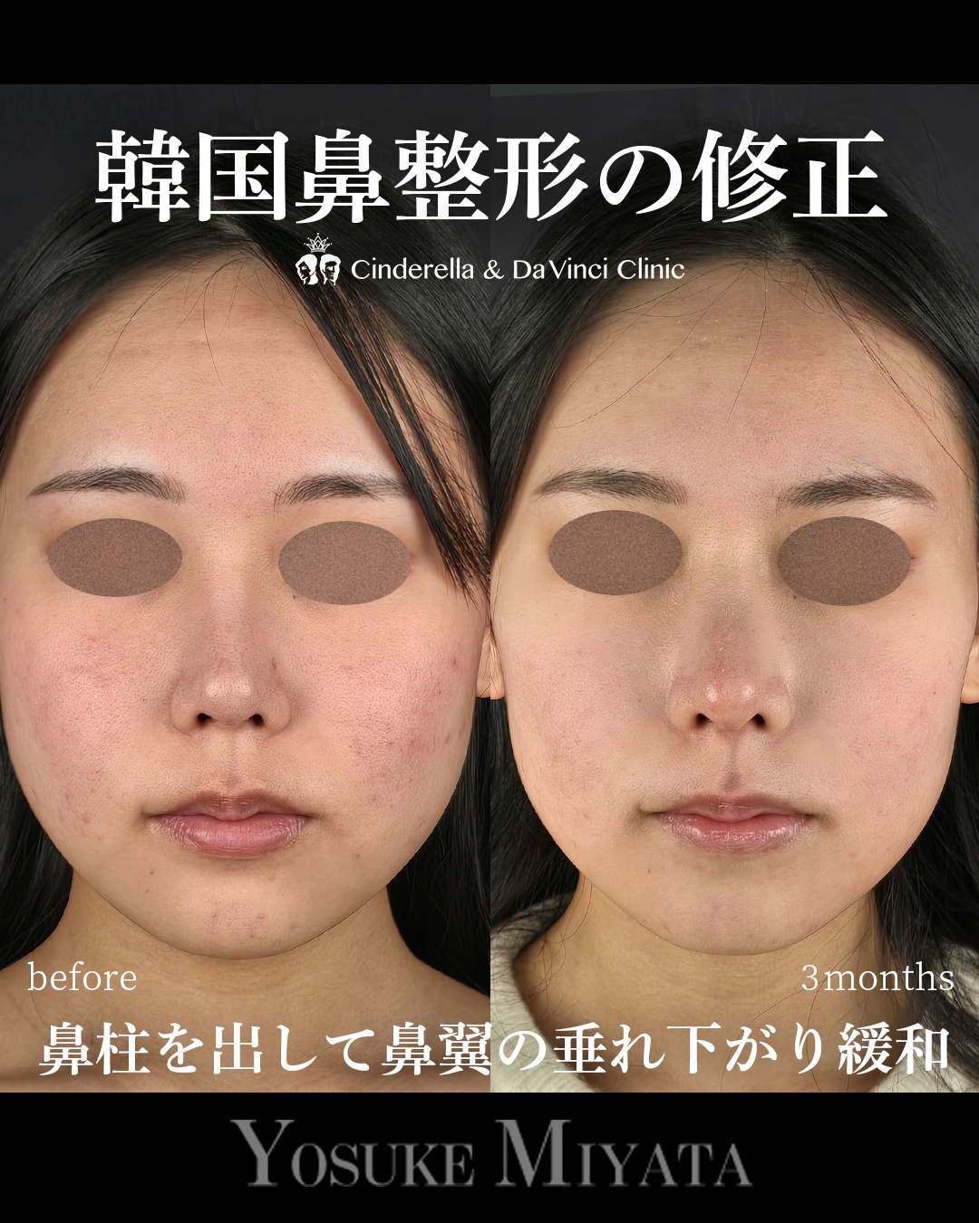 韓国鼻整形の修正の画像