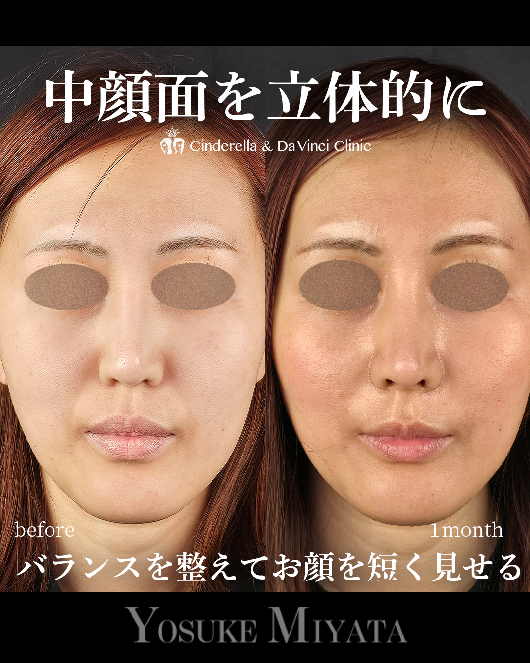 鼻整形で面長改善の画像