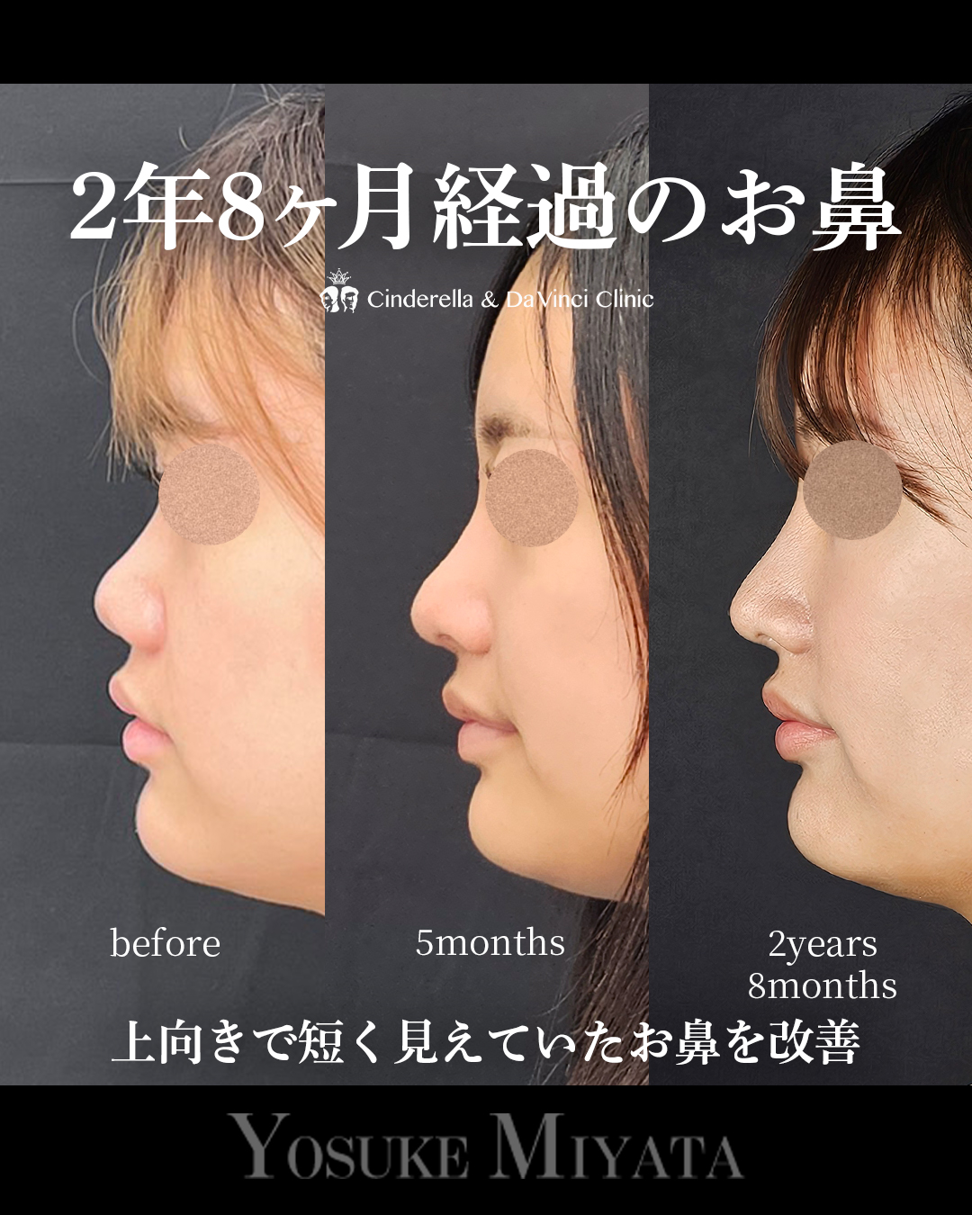 2年8ヶ月のお鼻