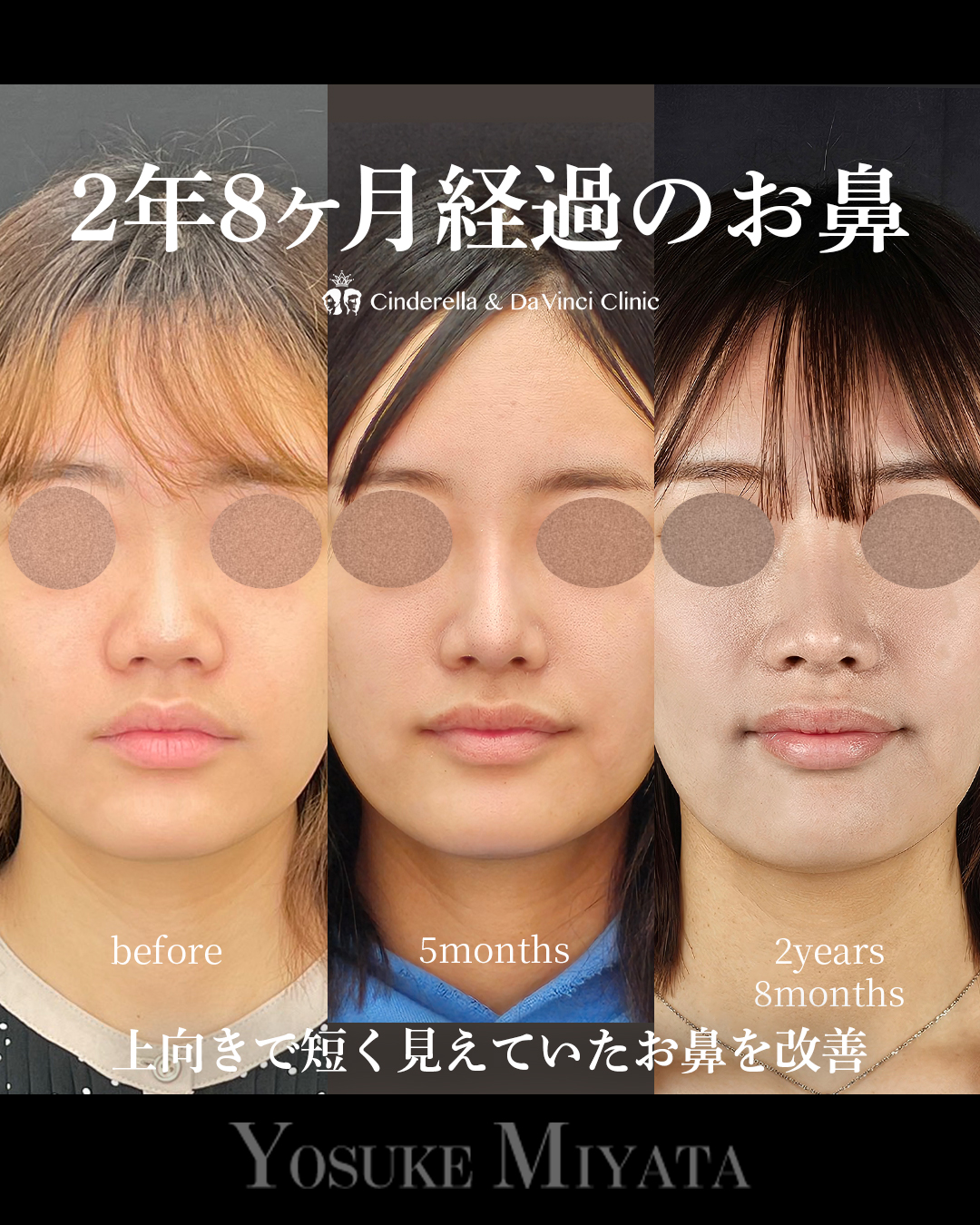 2年8ヶ月のお鼻の画像