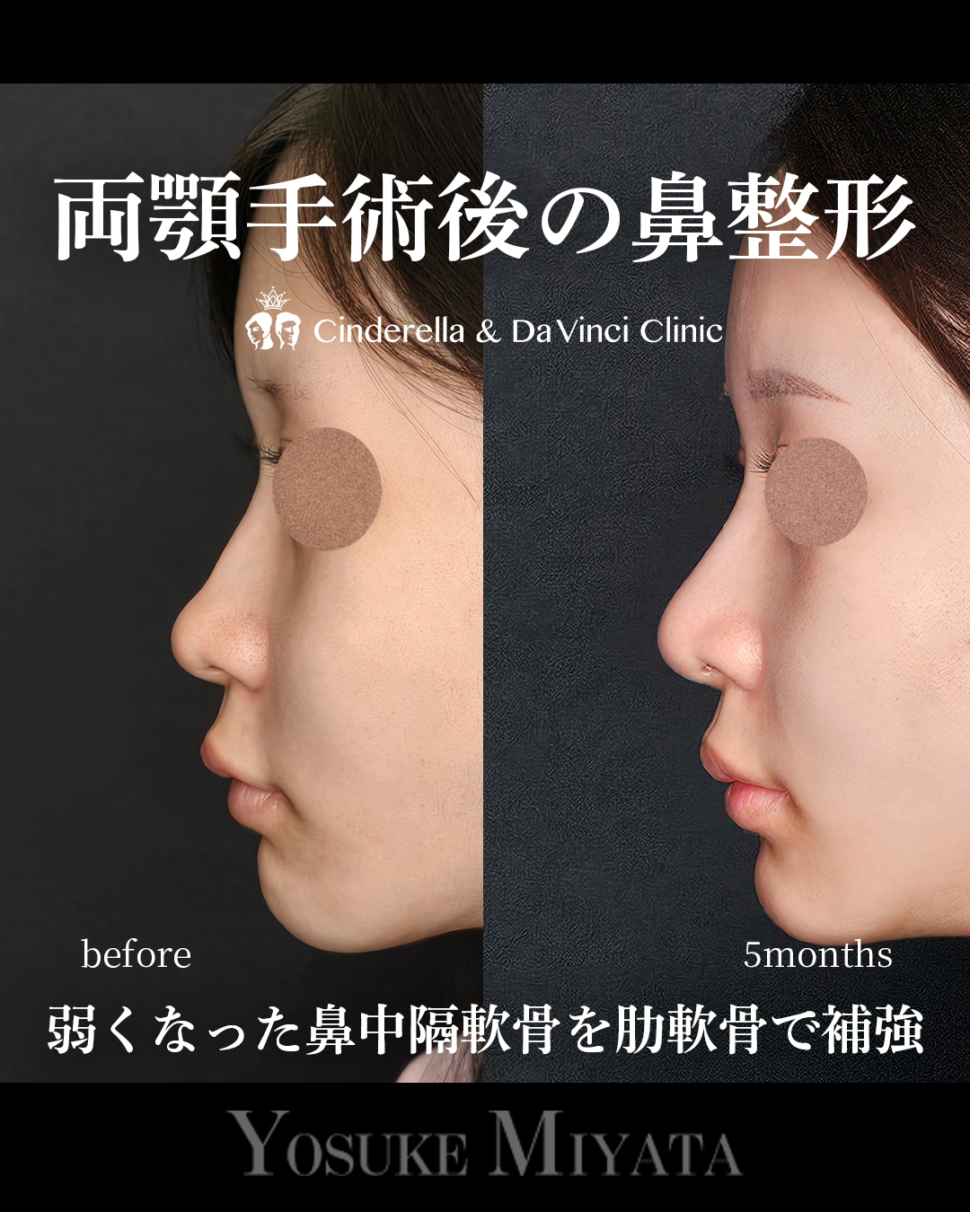 両顎後の鼻整形