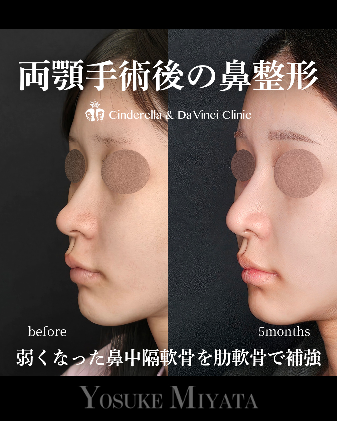 両顎後の鼻整形の画像