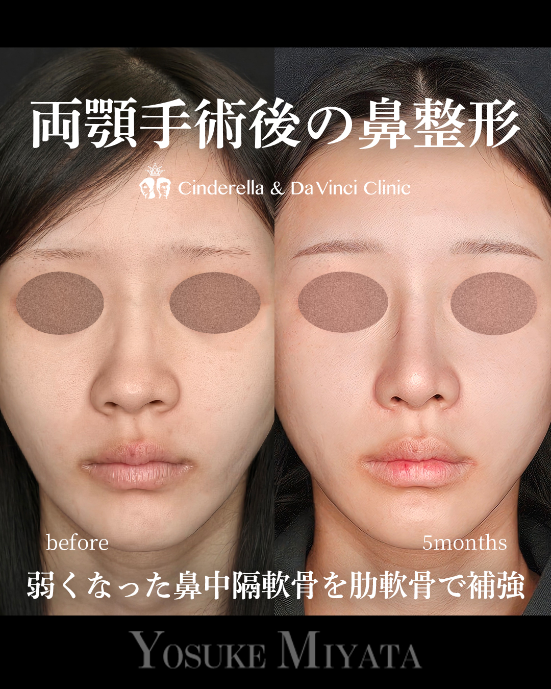 両顎後の鼻整形の画像