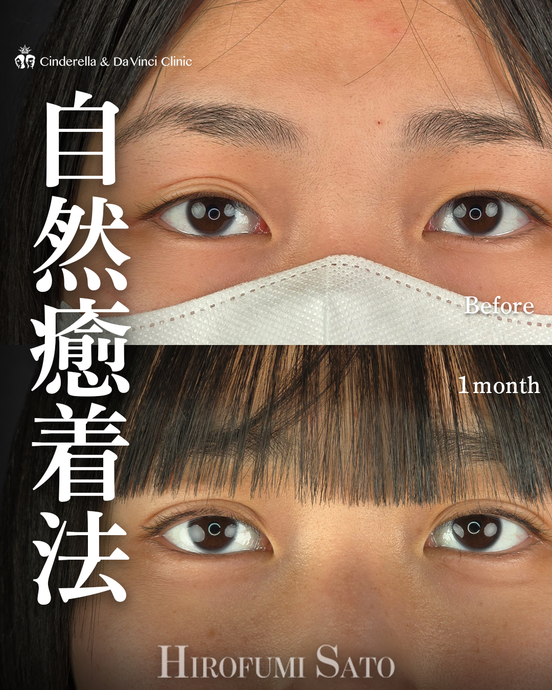 自然癒着で三重改善