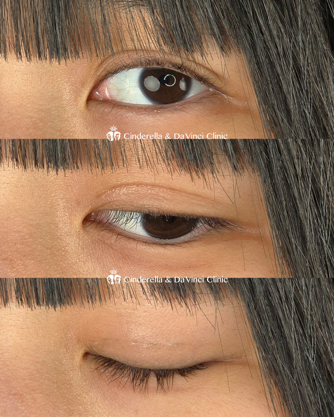 自然癒着で三重改善の画像