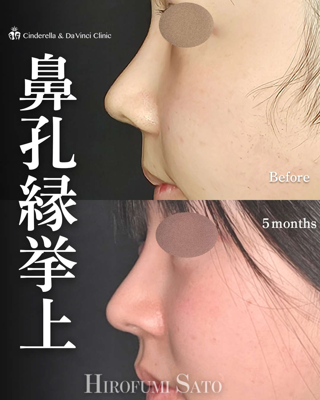 鼻孔縁挙上のみ