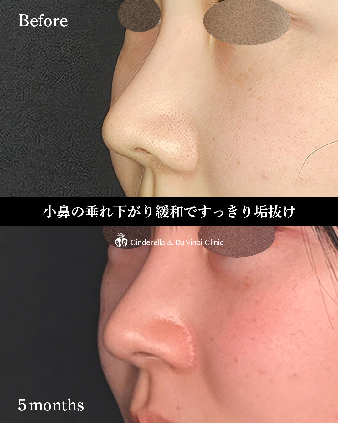 鼻孔縁挙上のみの画像